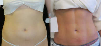 Vaser Lipo HD Liposuction Effects - Woman 